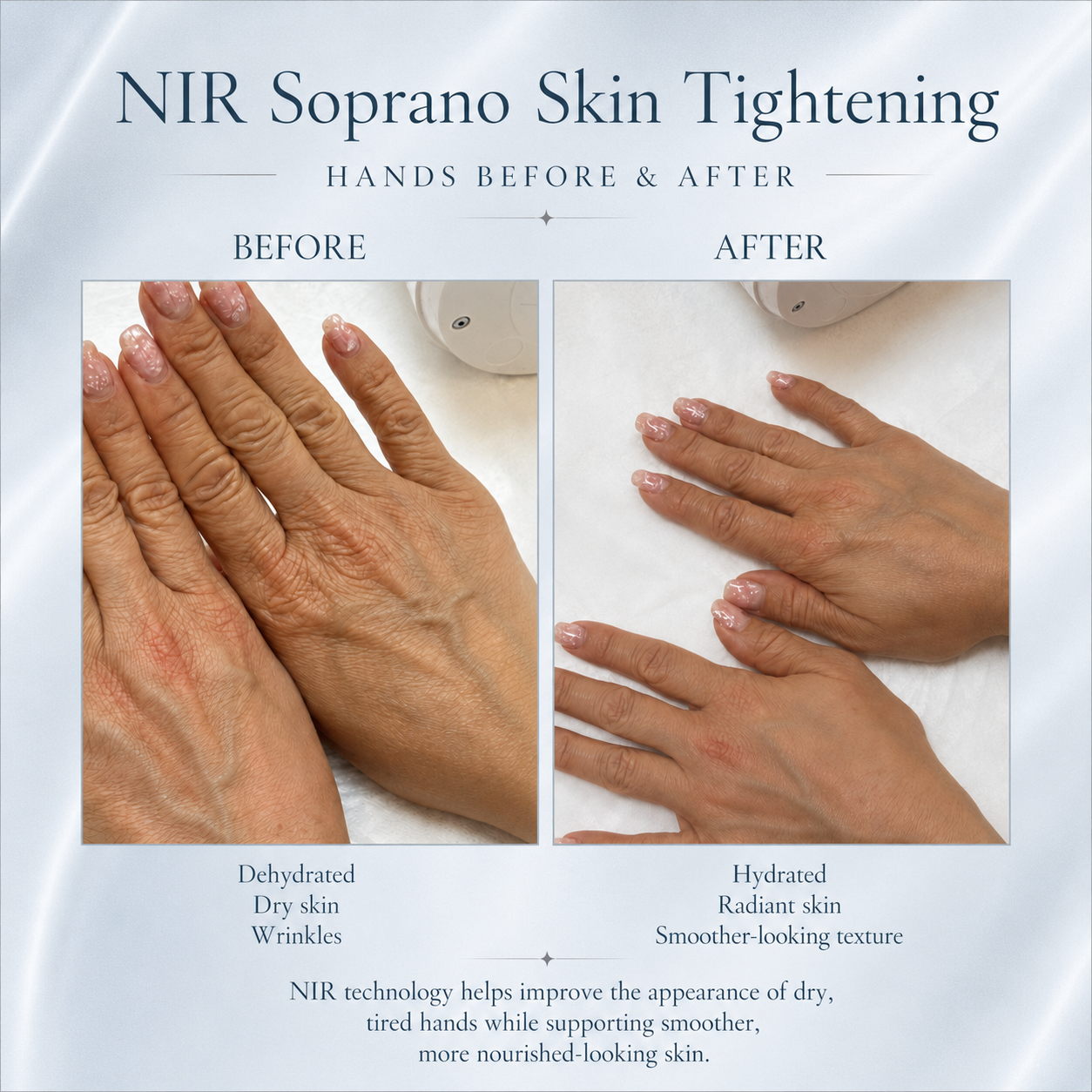 NIR Skin Tightening London | Face & Body | BeautyGene